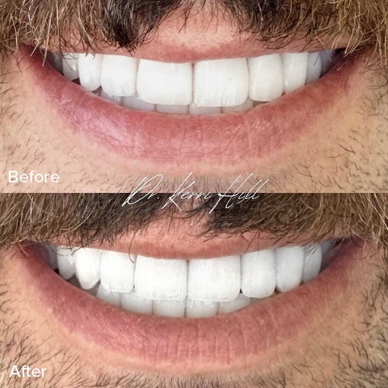 Dental Crowns Before & After Image