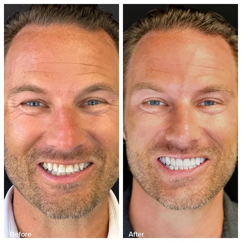 Veneers Before & After Image