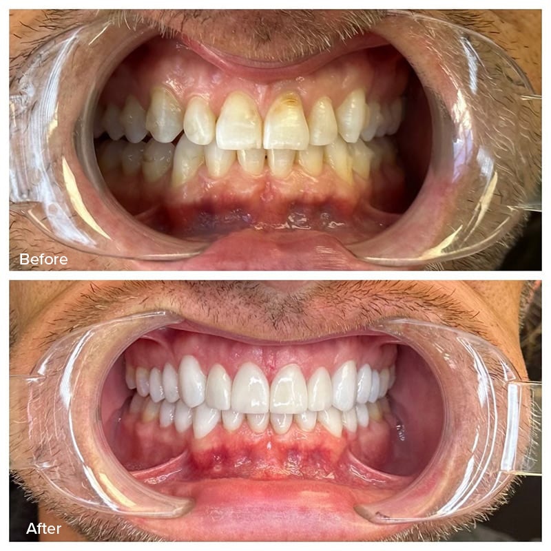 Veneers Before & After Image