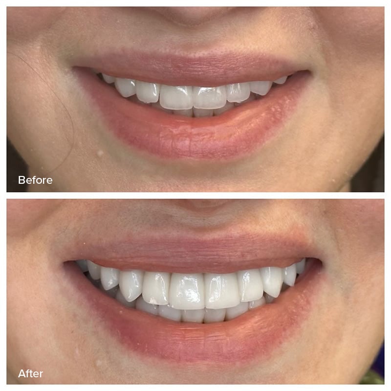 Veneers Before & After Image