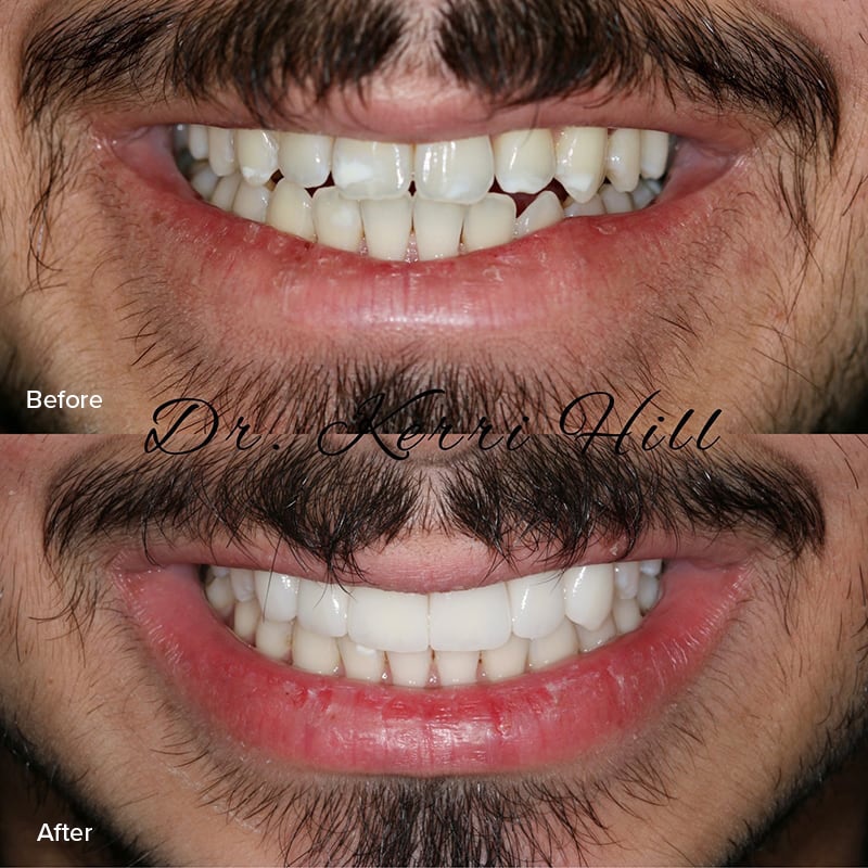 Veneers Before & After Image