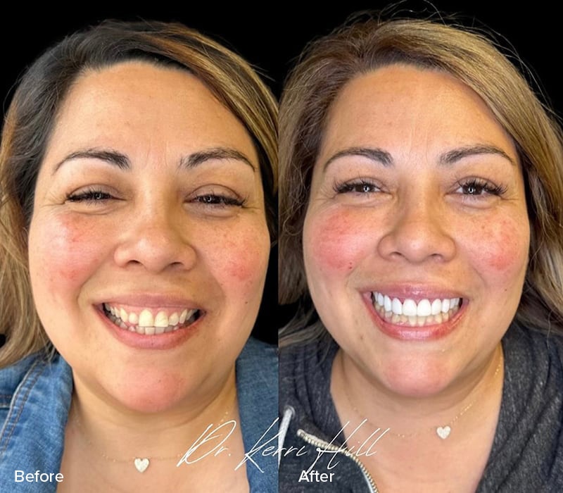 Veneers Before & After Image