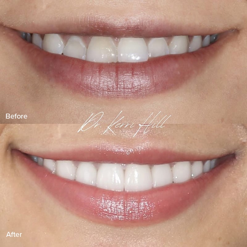 Veneers Before & After Image