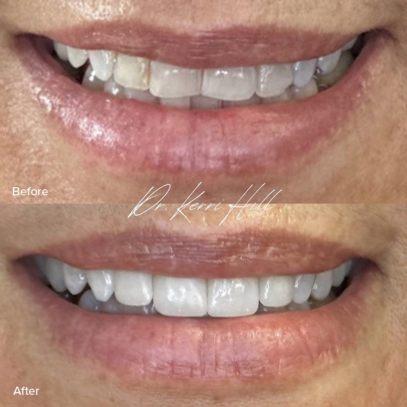 Veneers Before & After Image