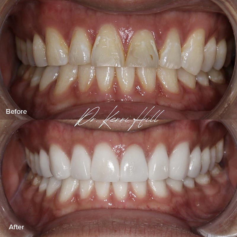 Veneers Before & After Image