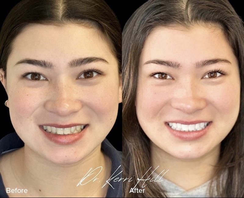 Veneers Before & After Image