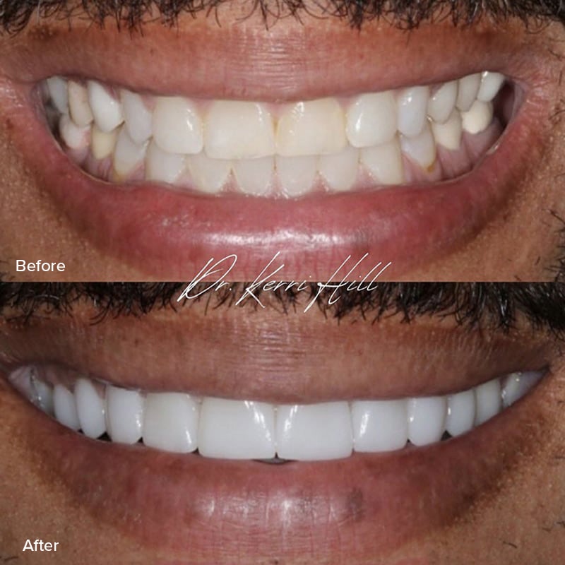 Veneers Before & After Image