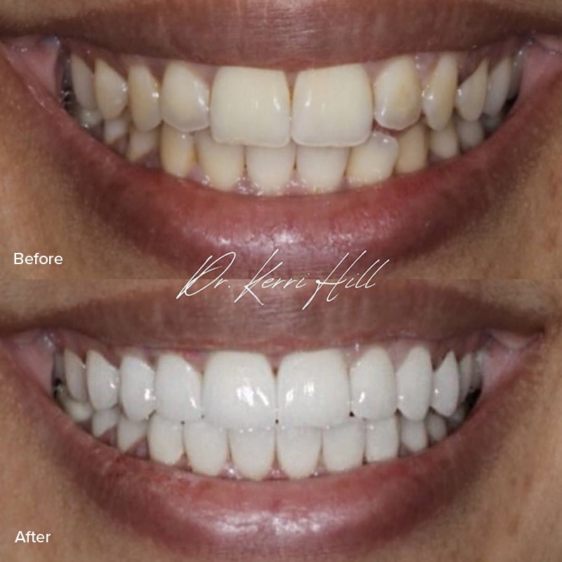 Veneers Before & After Image
