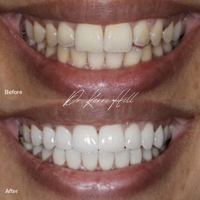 Veneers Before & After Image