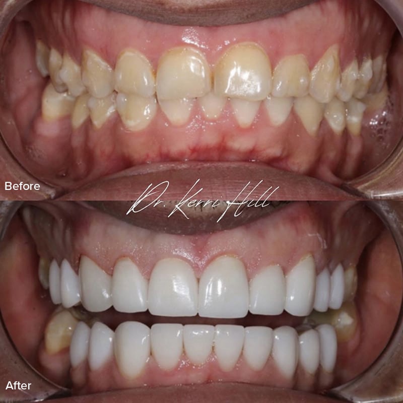 Veneers Before & After Image