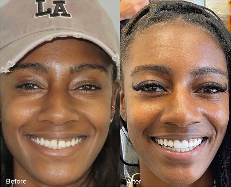 Veneers Before & After Image