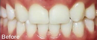 Veneers Before & After Image