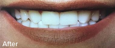 Veneers Before & After Image