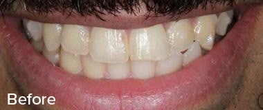 Veneers Before & After Image