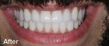 Veneers Before & After Image