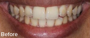 Veneers Before & After Image