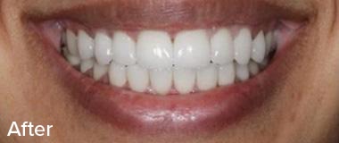 Veneers Before & After Image