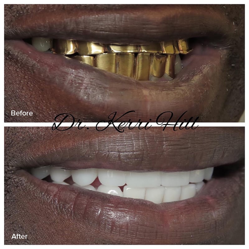 Dental Implants Before & After Image