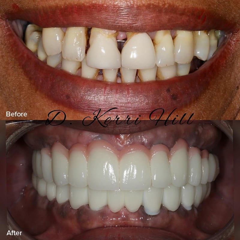 Dental Implants Before & After Image