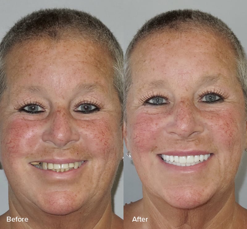 Dental Implants Before & After Image