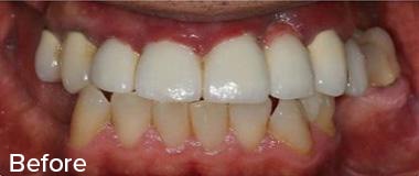 Dental Implants Before & After Image