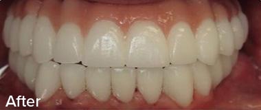 Dental Implants Before & After Image